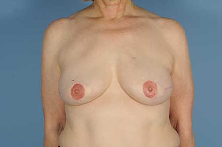 ​    ​​   Postmastectomy Breast Reconstruction with Bilateral Autologous Tissue, Nipple Reconstruction, and Areolar Tattooing