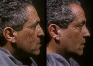 Detailed analysis of the same sides of the faces of two concordant, non-mirrored MZ twins reveals striking similarities
