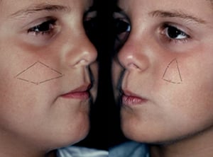 Both twin A (left) and twin B (right) exhibit a polygon of nevi only on opposite cheeks.